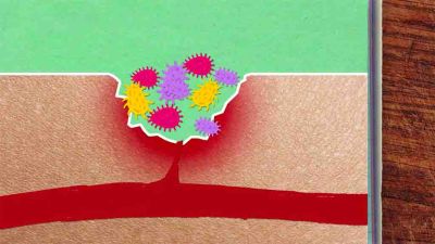 Proč se tvoří pupínky?